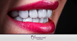 ابتسامه هوليود